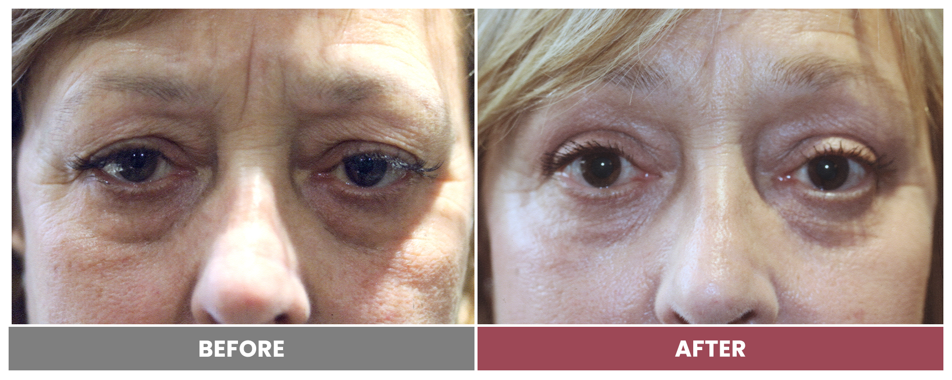 Upper Blepharoplasty - Case 53